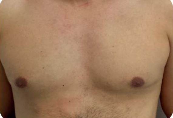 Epilare definitiva after