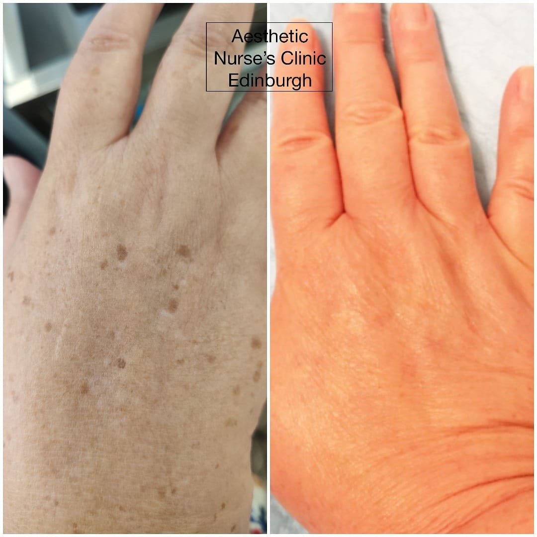 Tratament pete lentigo Plasmage before and after