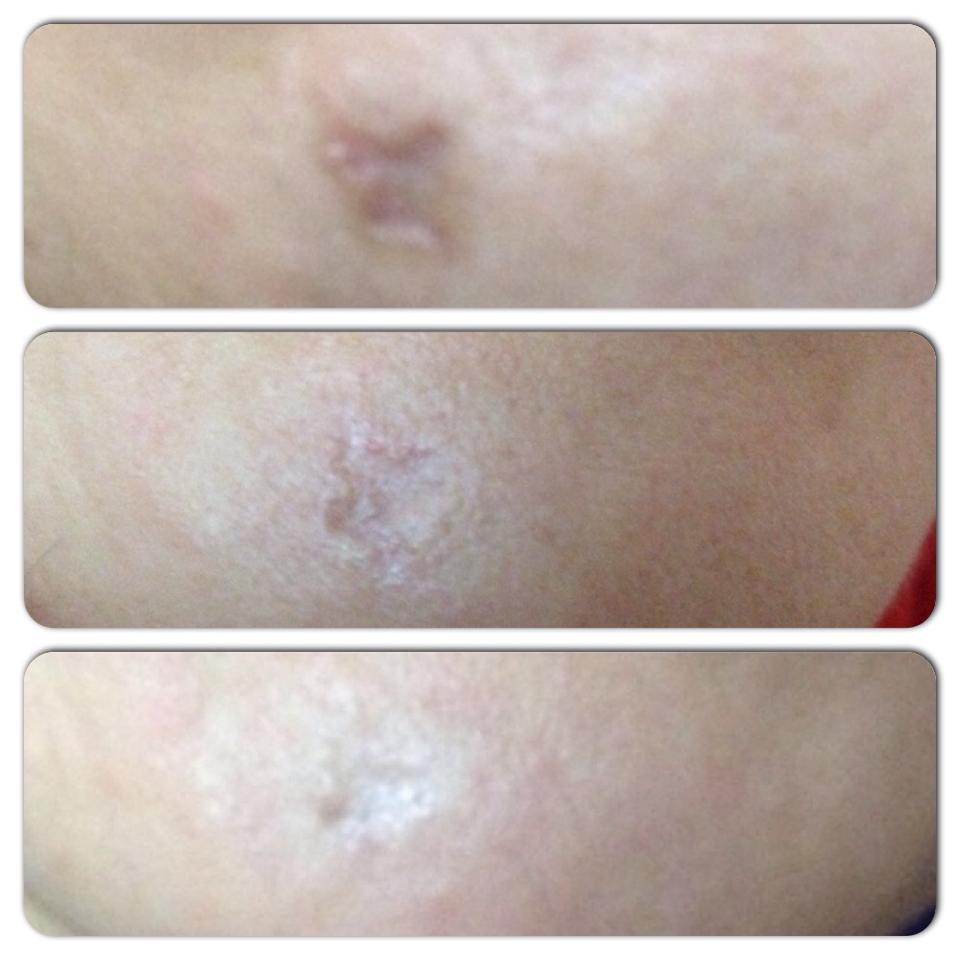 Tratament cicatrici Plasmage before&after