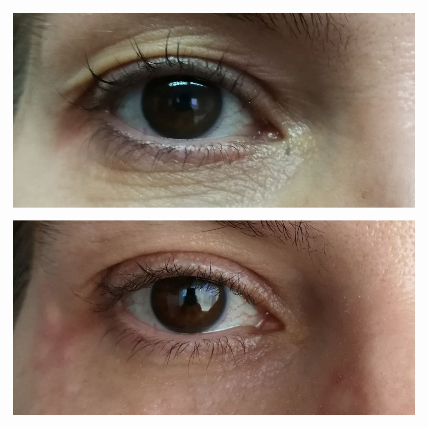 Blefaroplastie Plasmage pleoape cazute before&after