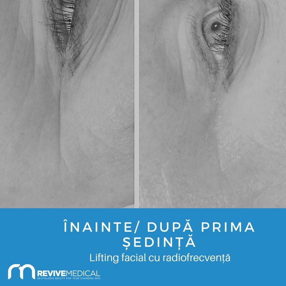 Rezultate lifting facial