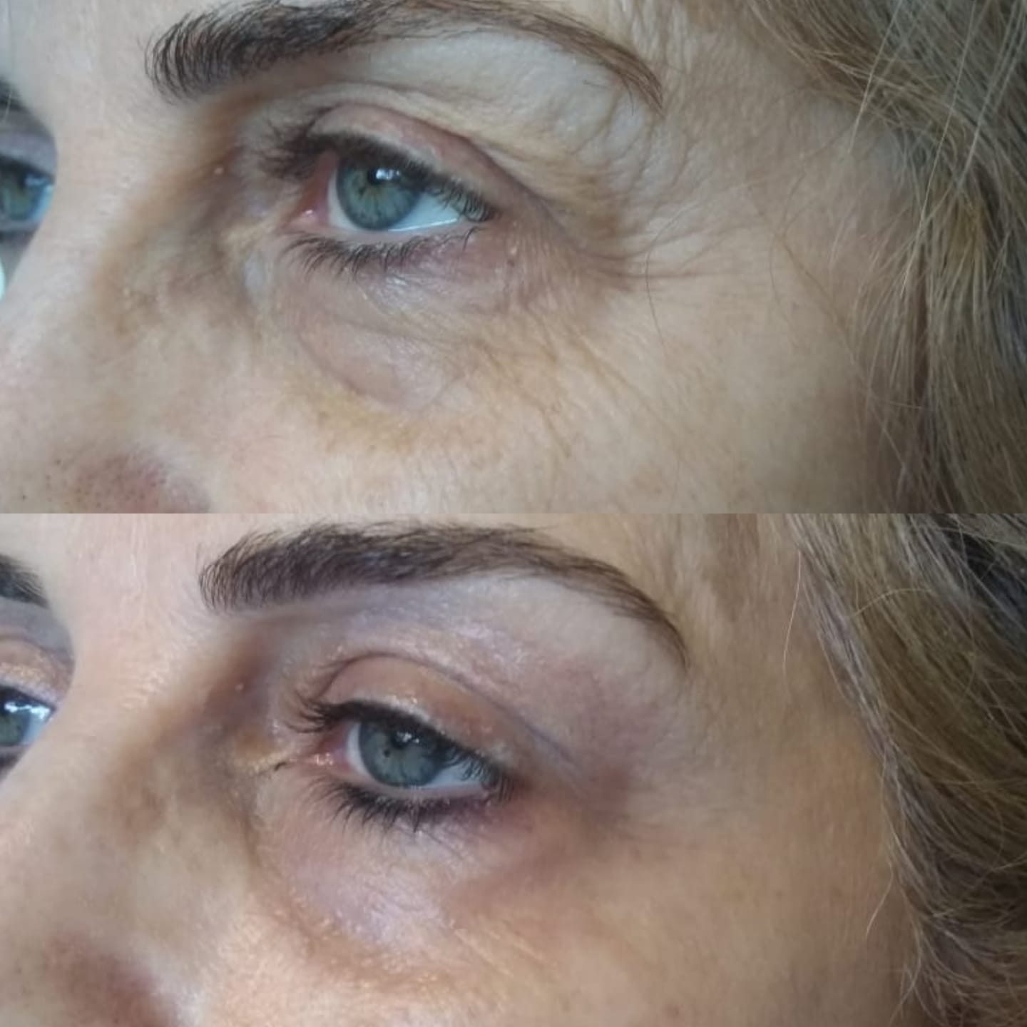 Tratament riduri Plasmage before&after