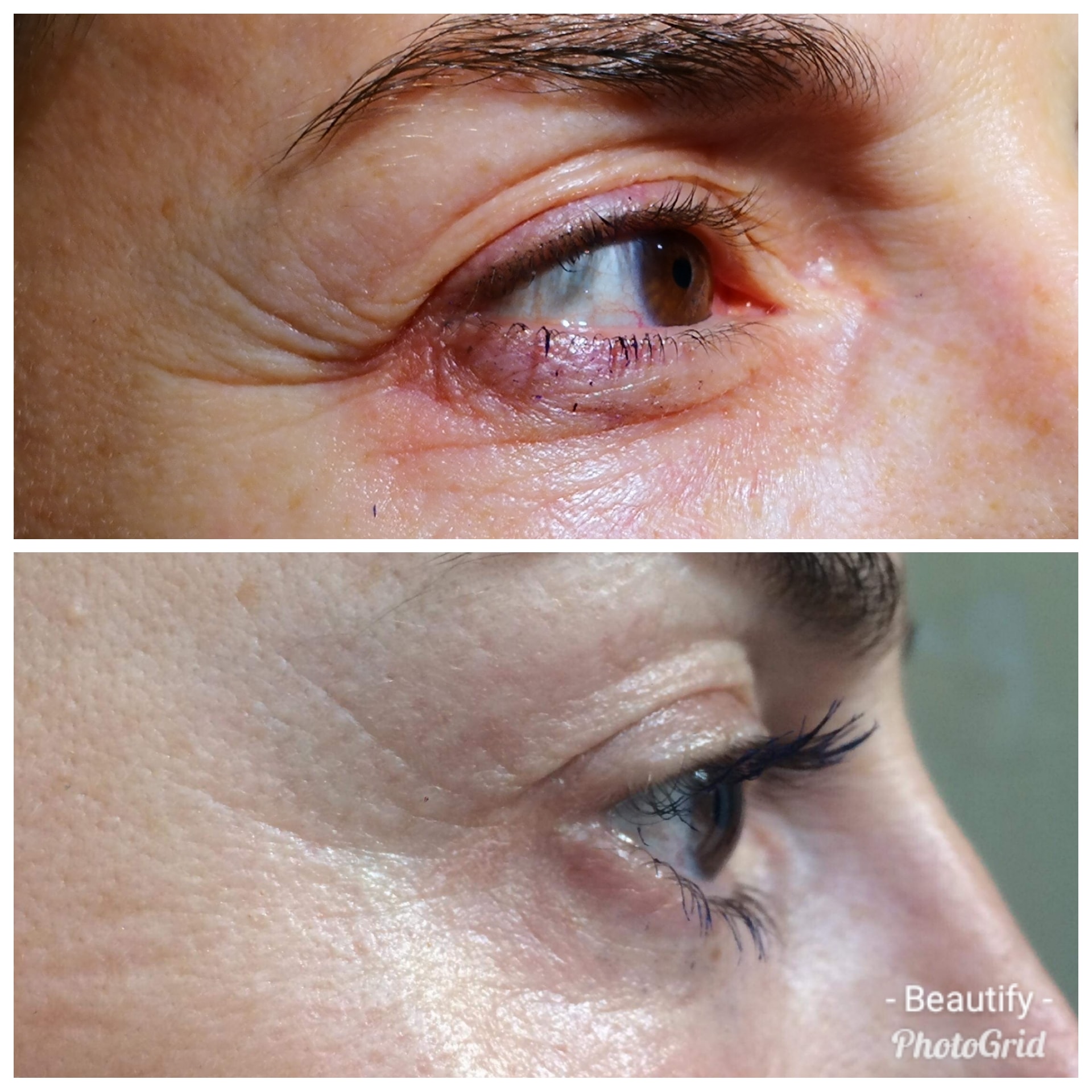 Tratament riduri Plasmage before&after