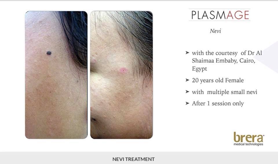 Tratament keratoza Plasmage before&after