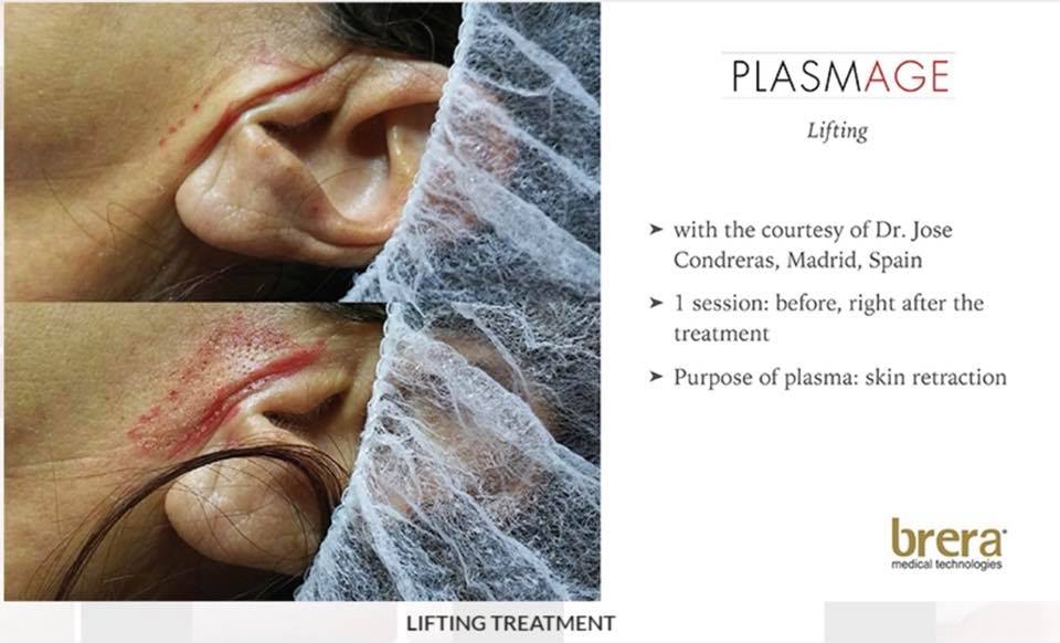 Tratament riduri Plasmage before&after
