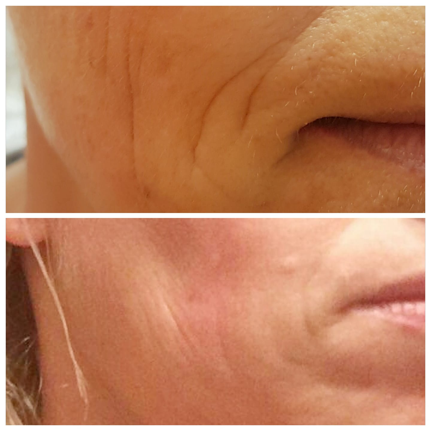 Tratament riduri Plasmage before&after