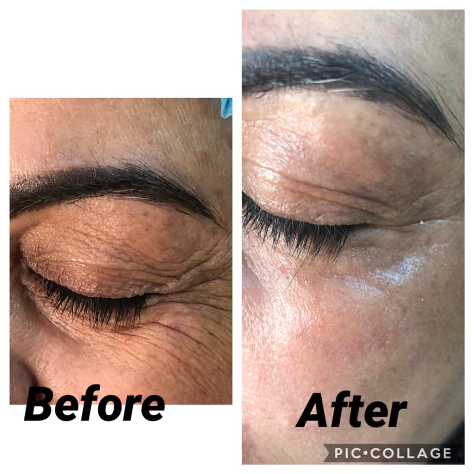 Tratament riduri Plasmage before&after