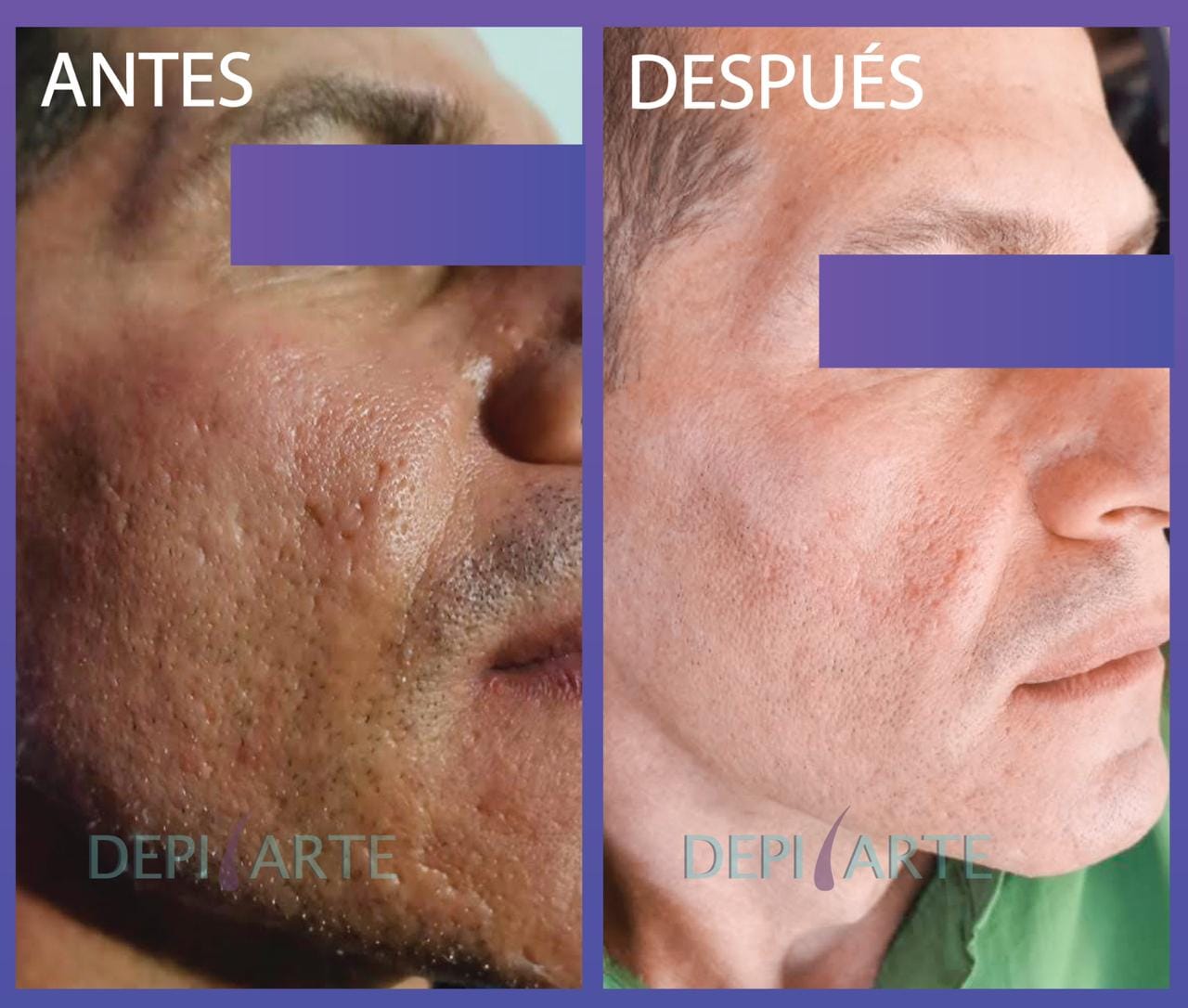 Tratament cicatrici postacneice Plasmage before&after