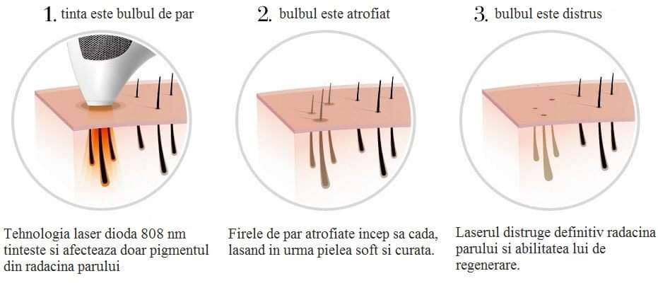 Epilare definitiva laser medical Primelase